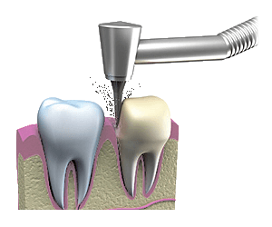 Illustration of tooth being prepared for a dental crown