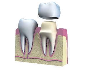 Dental crown being placed on tooth