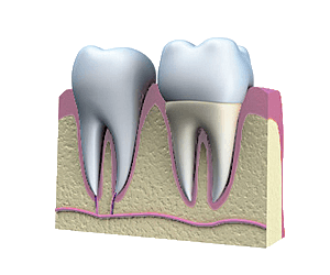 Dental crown sits on prepared tooth