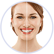 picture shows one side of smile with invisalign aligners