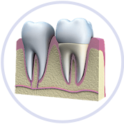 a dental crown